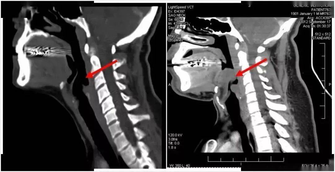 会厌_气管_什么