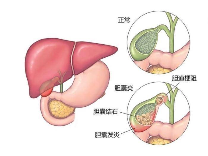 胆囊结石卡通图片图片