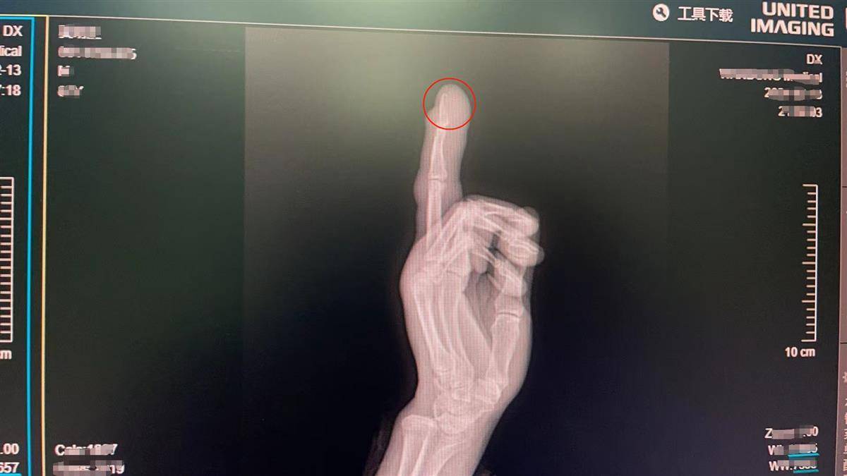 用锤子锤地漏时,不小心砸到了左手中指,手指顿时肿胀,疼得没法活动