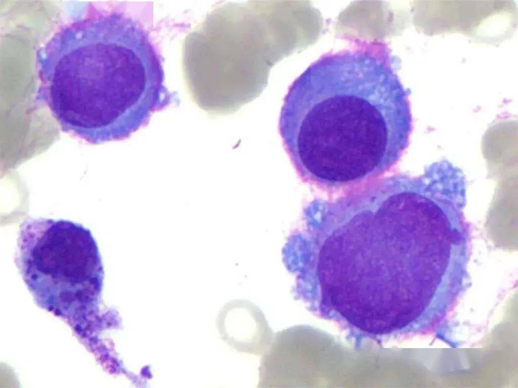 【病例分享】骨髓转移性恶性黑色素瘤_皮肤_临床_恶性肿瘤