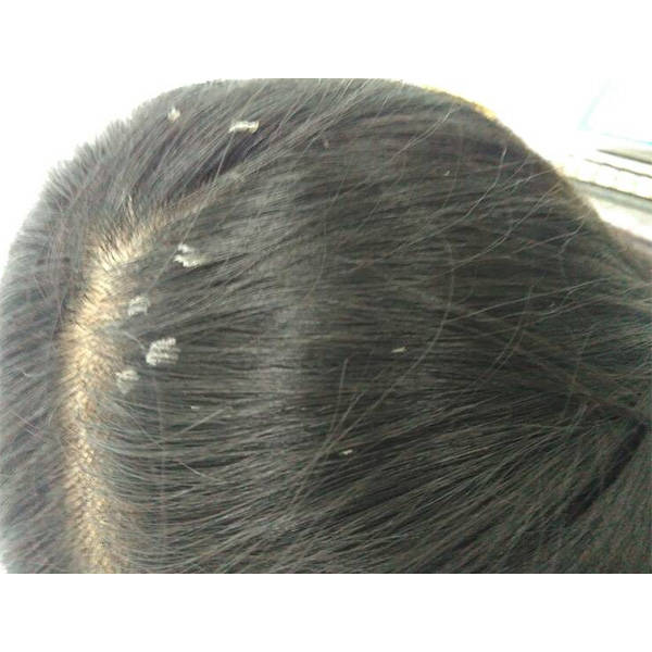 头皮屑和头痒通常由多种原因引起:脂溢性皮脂过多:头皮的过度油脂分泌