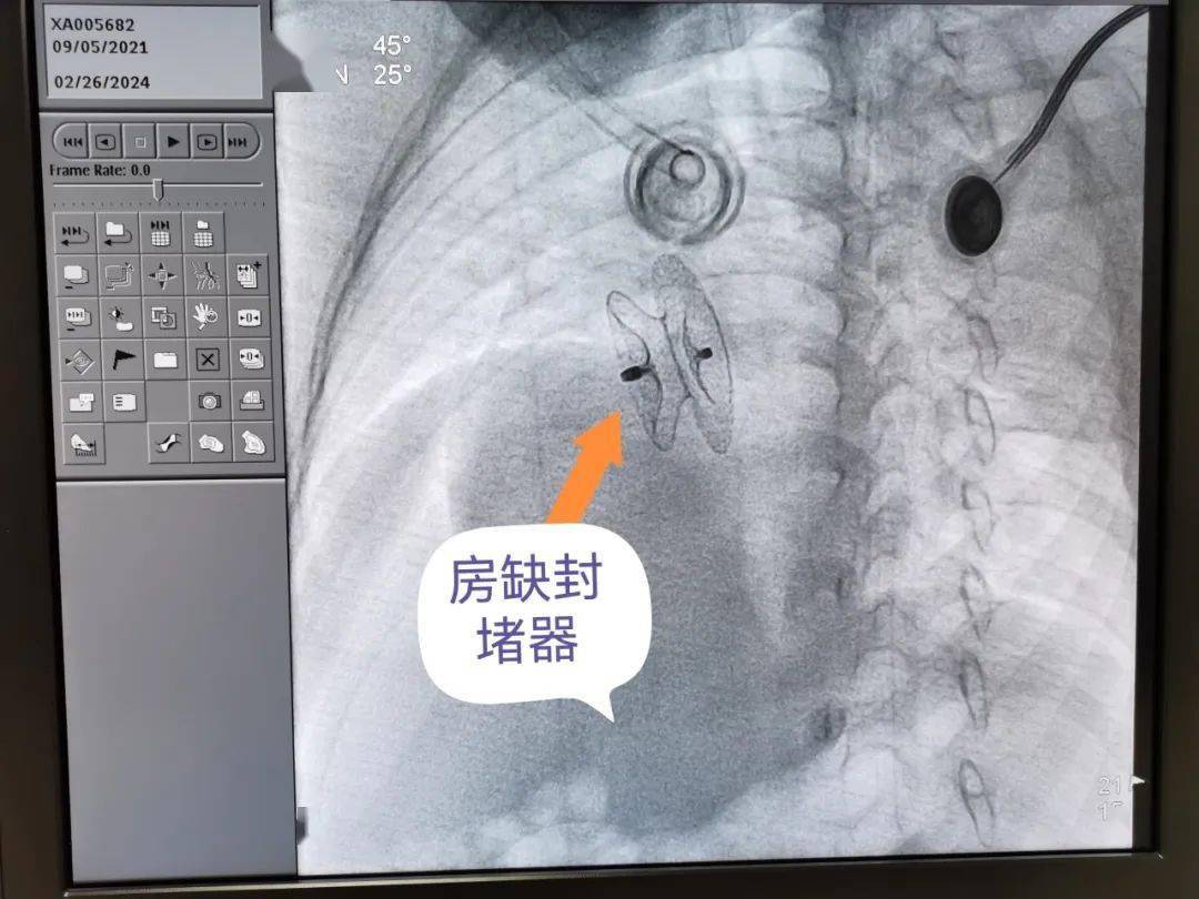 眼睑囊肿切除当导管室护士将小淇交到妈妈怀里,手术医生告知小淇父母