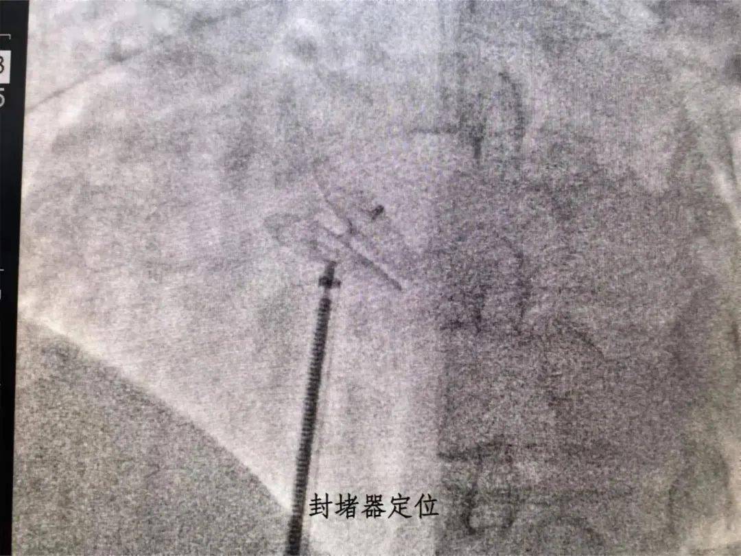 区人民医院成功开展我区首例卵圆孔未闭(pfo)封堵术_心血管_患者_心脏