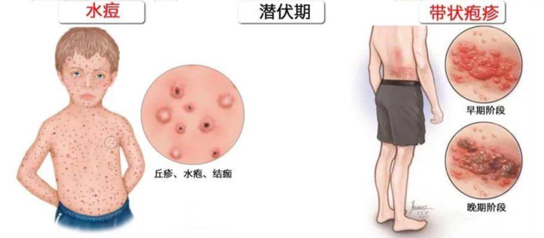 导致带状疱疹发病的"元凶"是一种名叫水痘—带状疱疹的病毒,相关研究