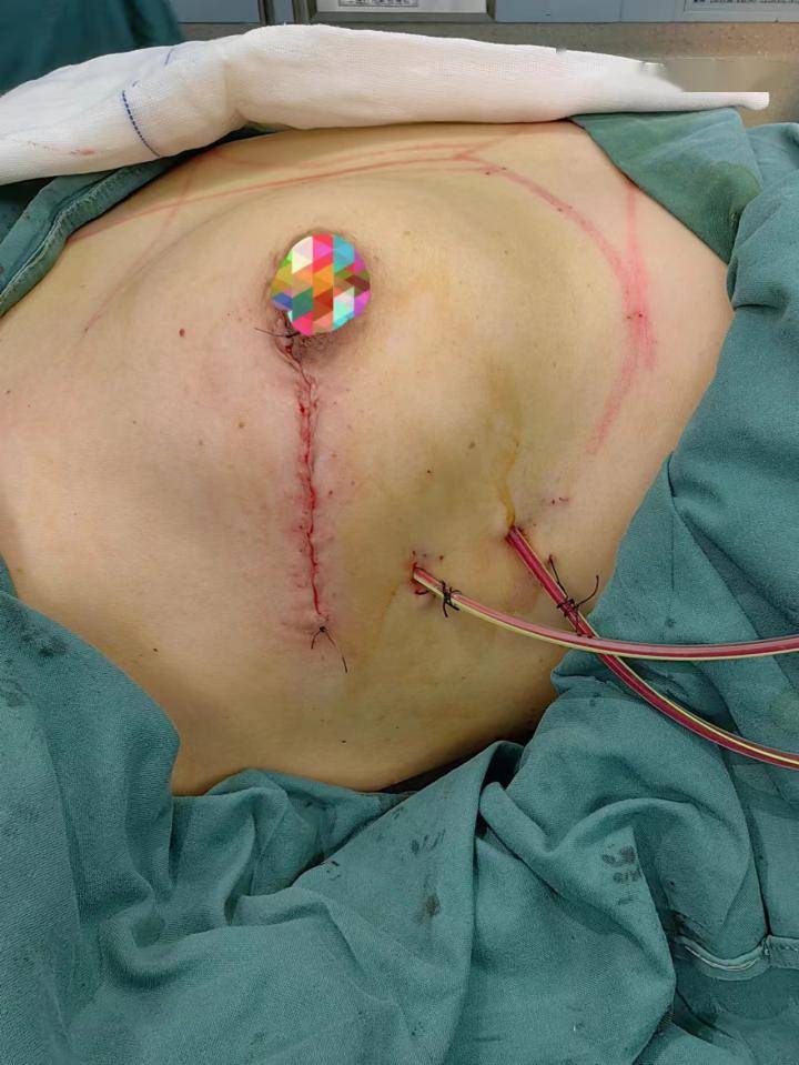 腹腔补片手术后图片图片