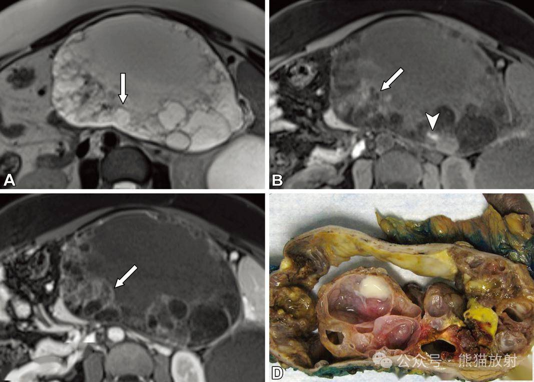 胰腺囊性病变及相关恶性肿瘤丨影像评估_信号_显示_女性