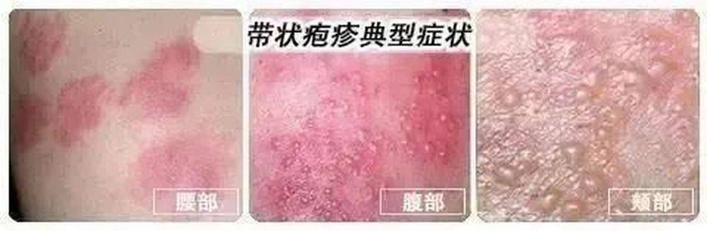 皮疹分布像一条长带,因常见于腰部,胸部,因此老百姓又叫它"蛇缠腰","