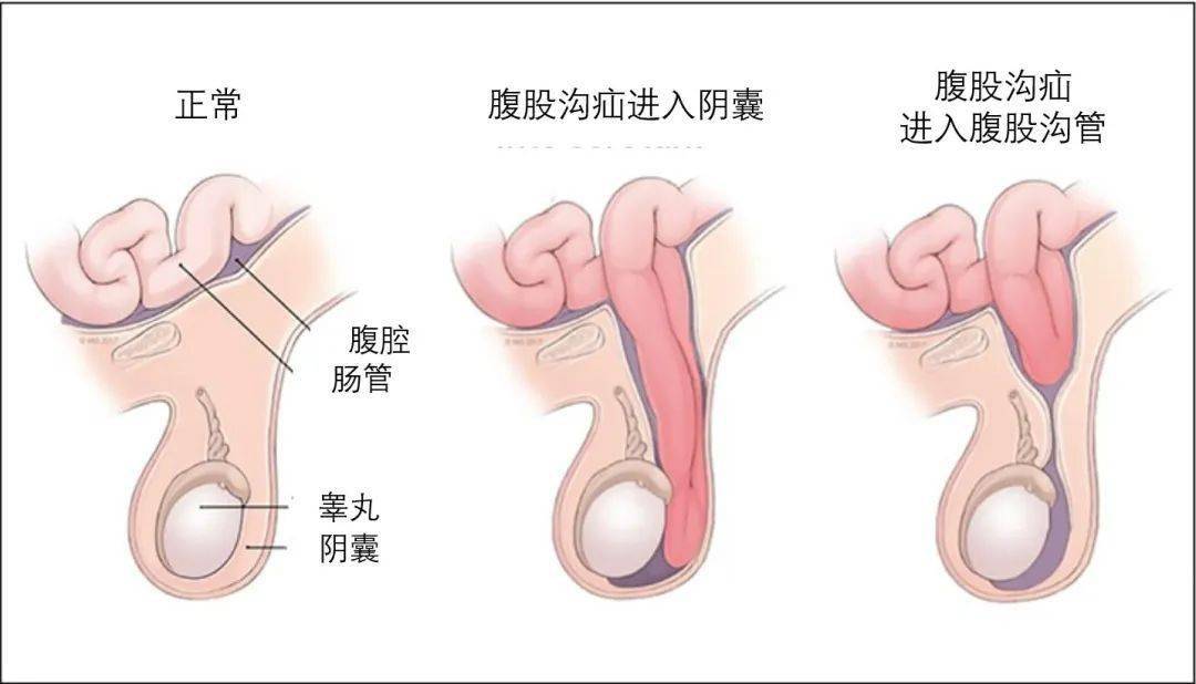 腹股沟疝危险三角区图片