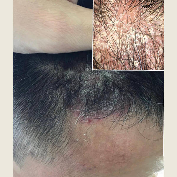 毛囊炎要用什么洗发水好