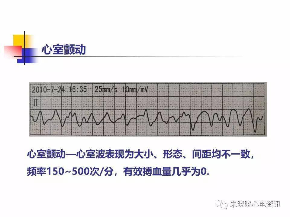 心电图危急值内容图片