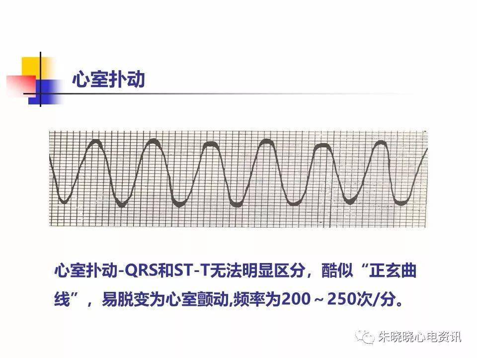 最新版心电图危急值图片