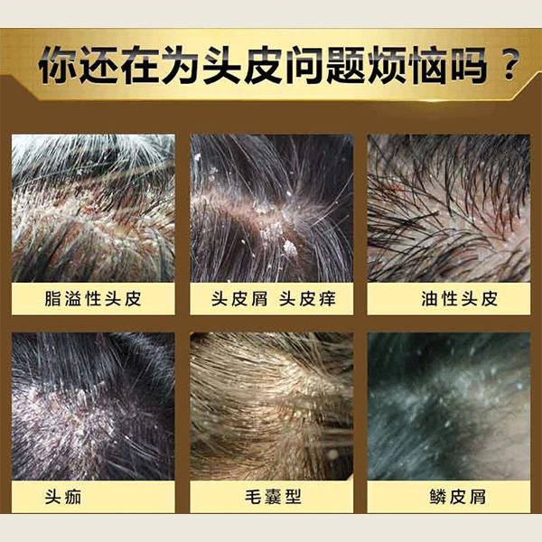 头皮毛囊炎用什么洗发水最好