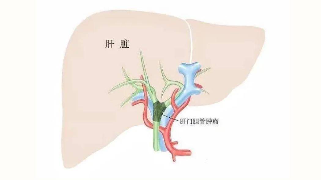 【重医三院·医疗动态】妙手回春,别平教授团队完成高难度肝门部胆管