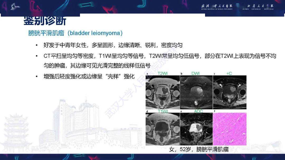 膀胱副神经节瘤影像诊断