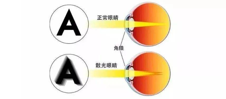 孩子一直都没散光怎么现在检查就有散光了
