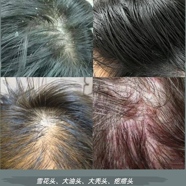 有什么去屑效果好的洗发水