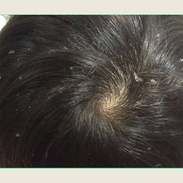 头皮_去屑_头发