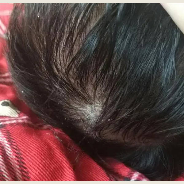 男生用什么洗发水去屑效果好