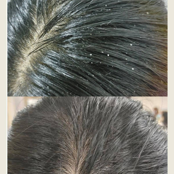 头发干枯毛躁有头屑用什么洗发水