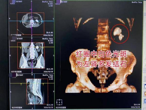 肾结石b超图片图片