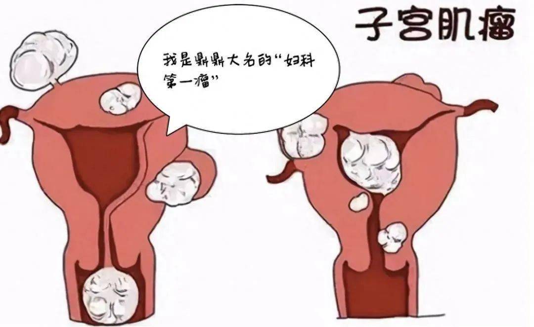 绝经后子宫肌瘤仍需警惕
