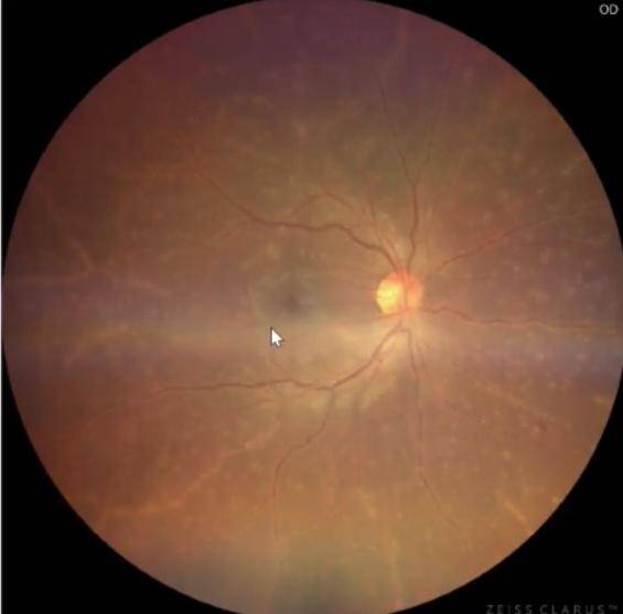 超广角眼底照相机拍摄技巧超实用