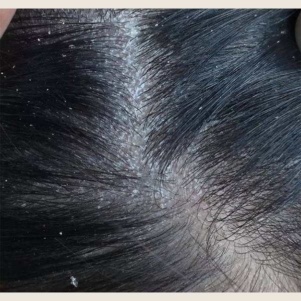 头皮屑是指头皮表面出现的脱落的小片皮肤碎屑.