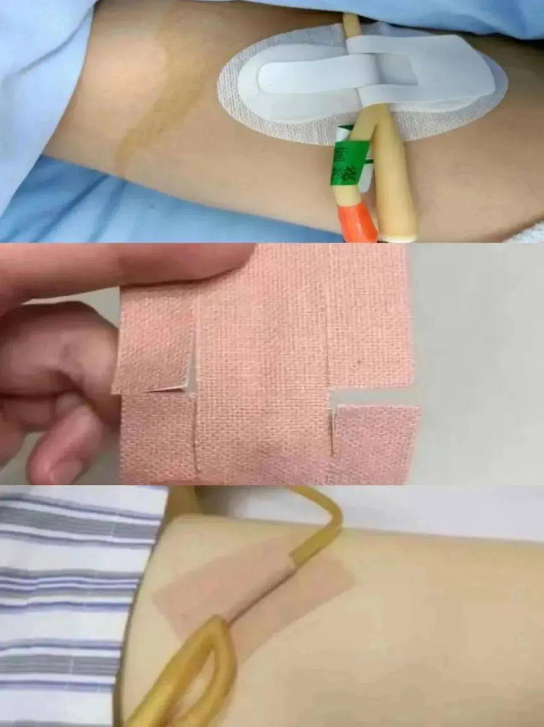 中线导管留置图