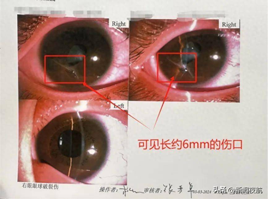 男孩帮妹妹换纸尿裤,意外被划破眼球_右眼_角膜_晶状体