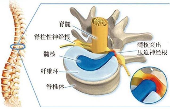 直击腰害