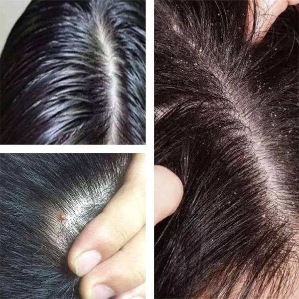 头皮屑通常是由头皮上的角质细胞过度脱落引起,可能受头皮干燥,真菌