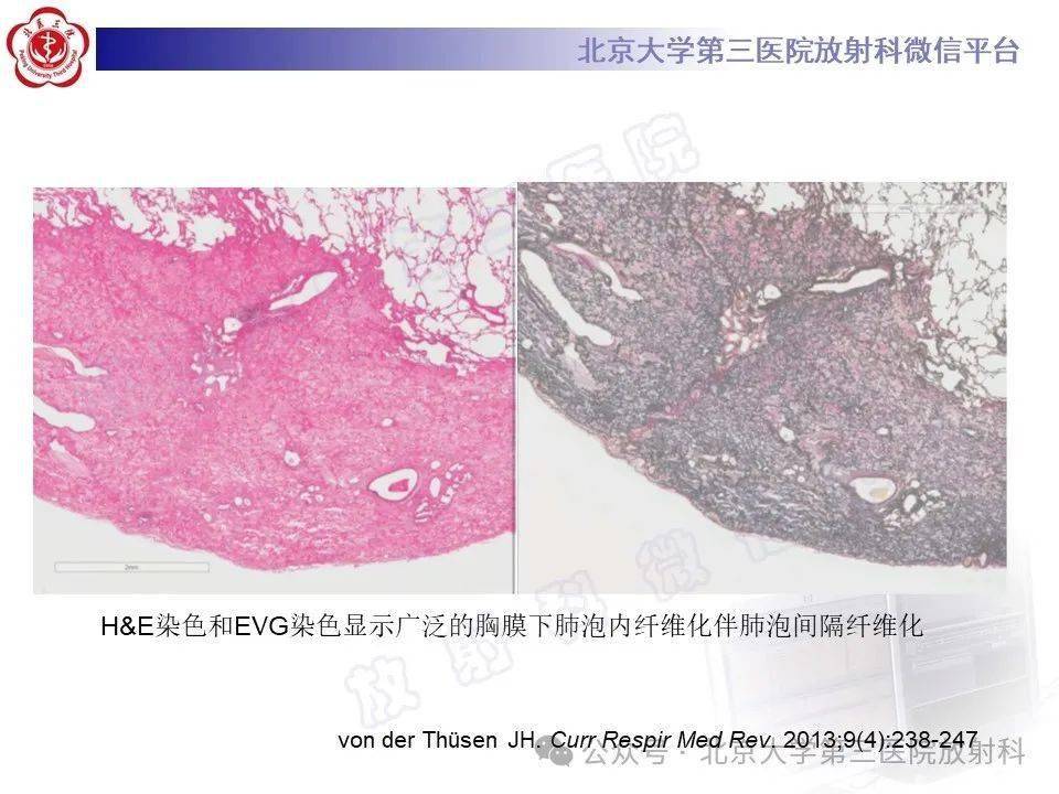 胸膜肺弹力纤维增生症