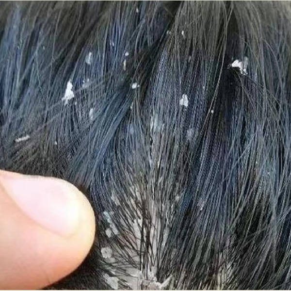 头皮屑红疹等头皮问题产生的原因:大块头屑,头痒,毛囊炎,小红疹和脂溢