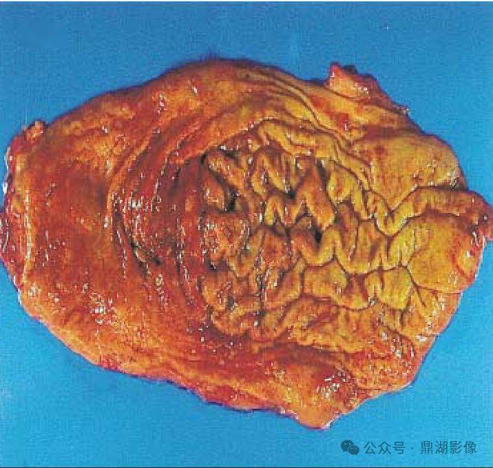 难得一见影像案例医疗圈热议的胃梅毒造影和ct表现如何呢