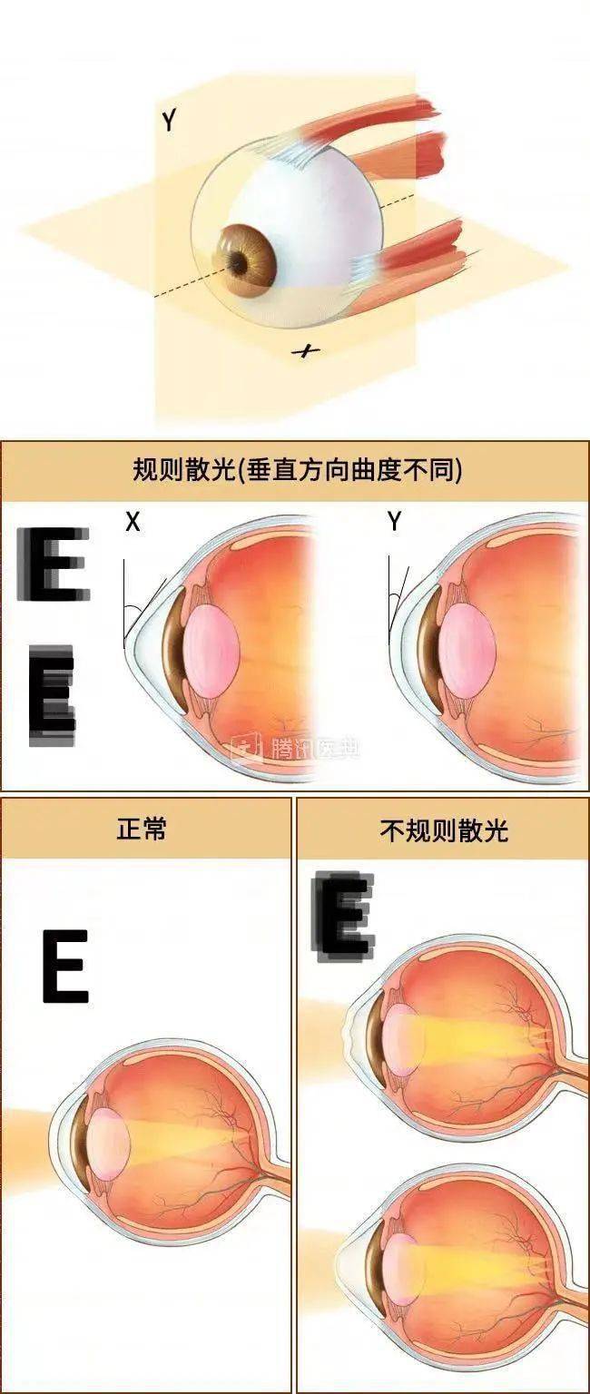 经常揉眼,会导致散光吗?