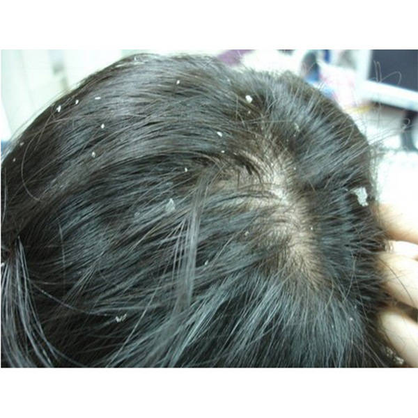 头皮屑多用什么洗头膏才好??_头发_成分_去屑