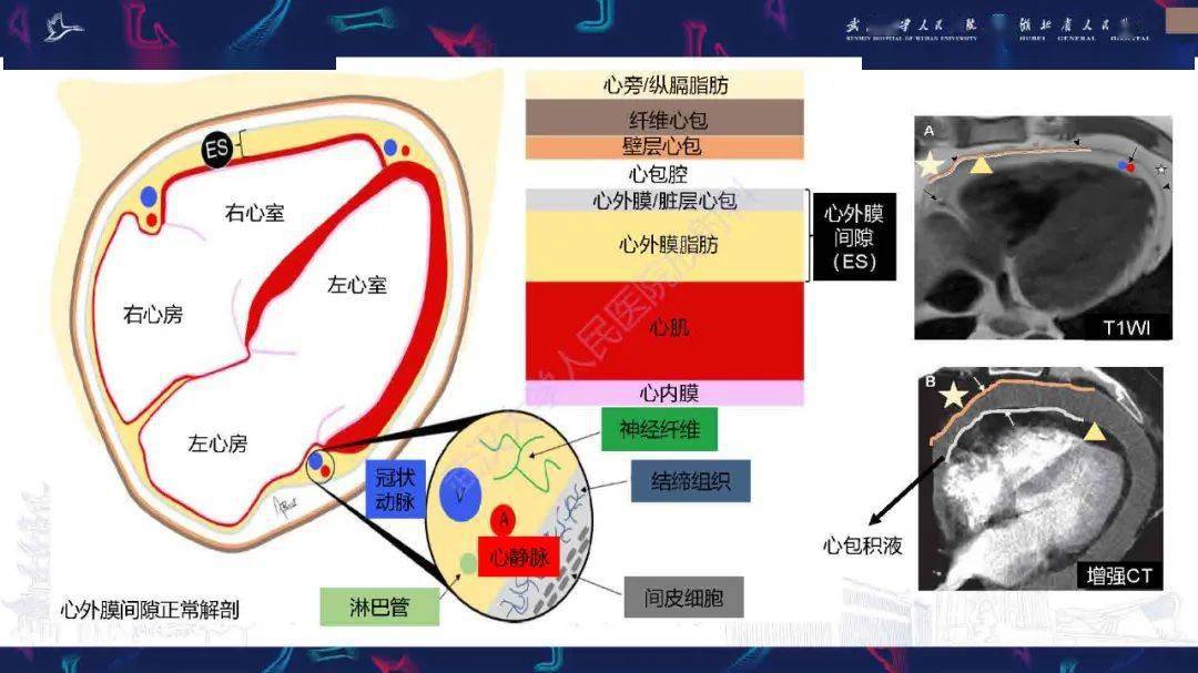 心外膜间隙病变影像诊断