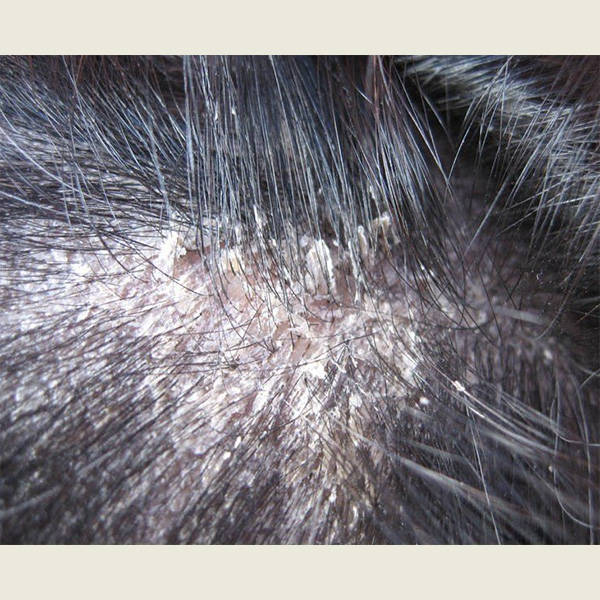 去除头皮屑最好的洗发水好的去头屑洗发水