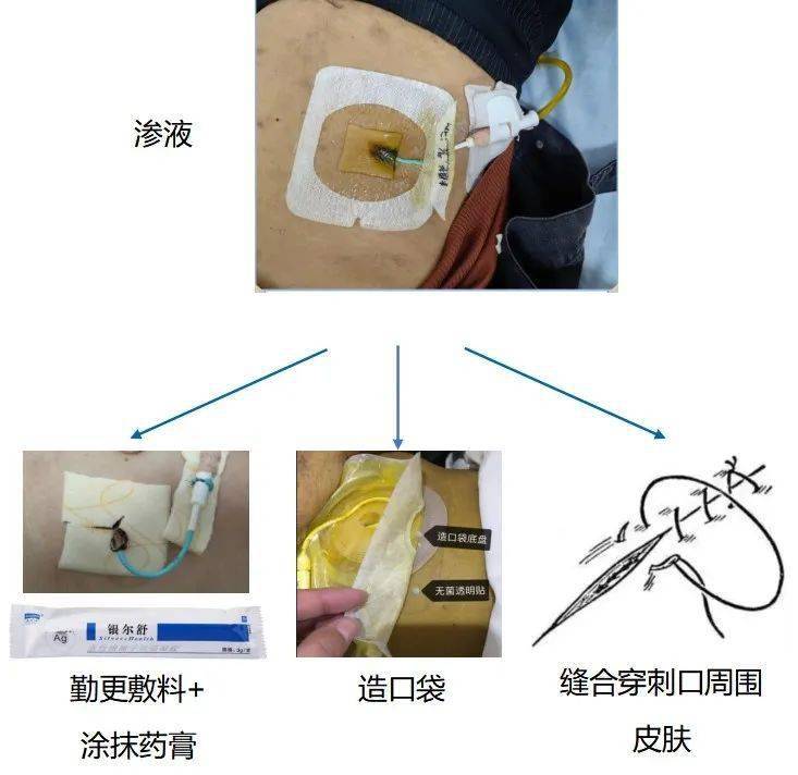"管"注细节,手"护"有道——科室ptcd管道规范化管理经验分享