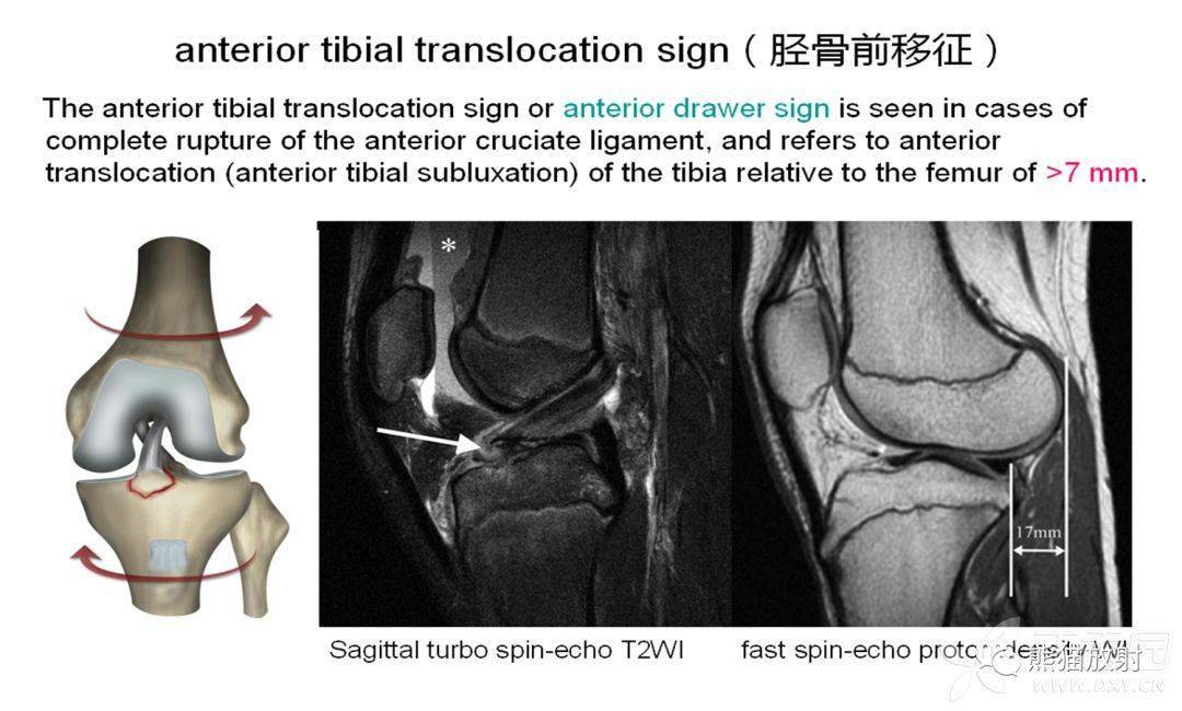 又称抽屉征,前交叉韧带完全断裂,胫骨向前半脱位,相对于股骨,胫骨前移