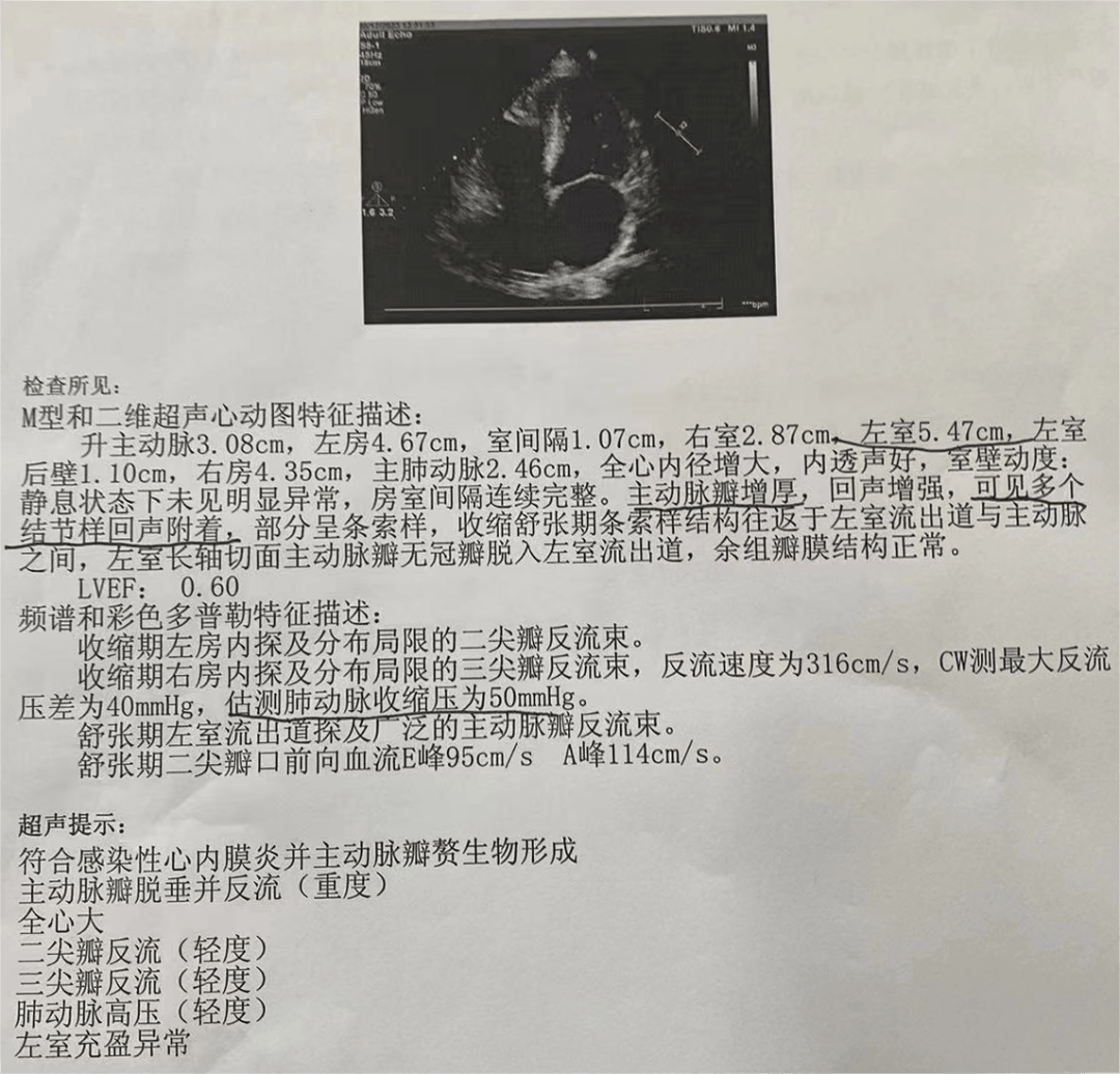 透析患者出现不明原因发热乏力贫血心悸低血压你第一个想到的原因是