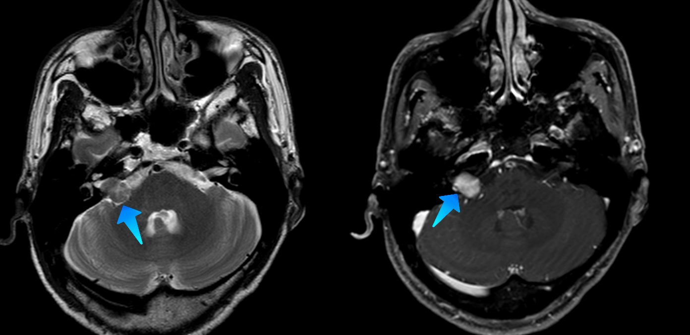 56岁男子右耳听力下降4年多,"元凶"原来是听神经瘤
