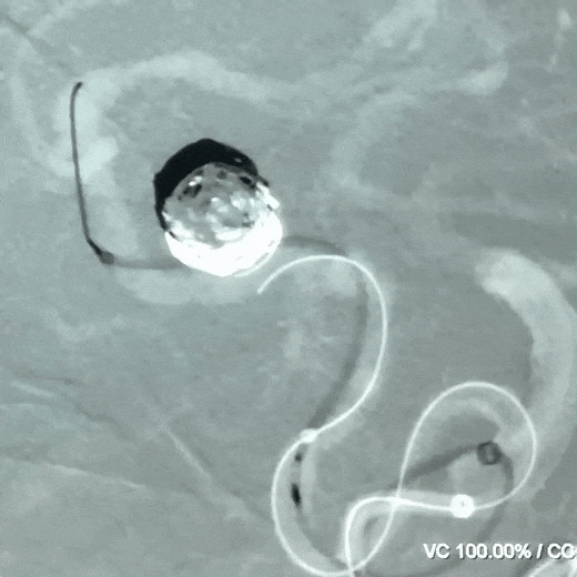 支架向远推送困难,决定采用原位释放,远端释放时支架头端顺利打开,中