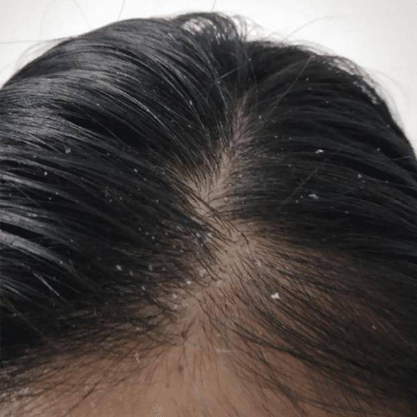 便宜好用的去屑洗发水?去屑止痒洗发水女士介绍_头皮屑_效果_问题