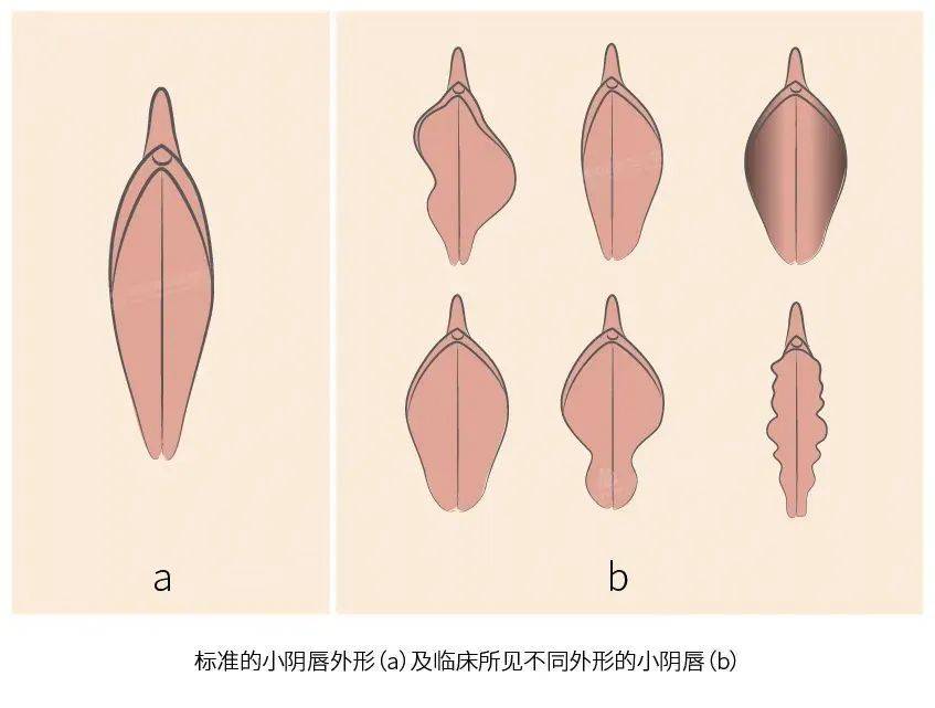小阴唇是位于大阴唇内侧一对薄的皱襞,一般长4~5cm,厚0.5cm.