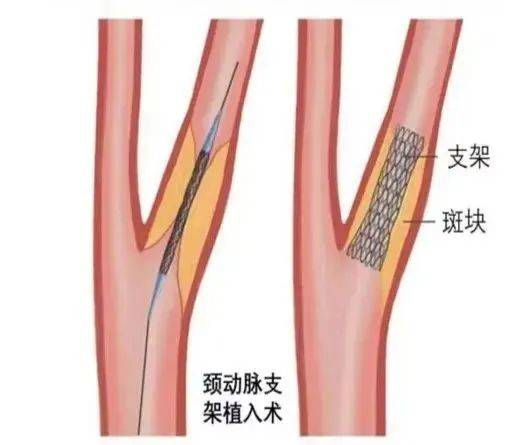 颈动脉支架示意图图片