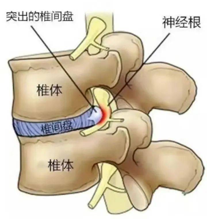 嘉鱼中医院:腰椎间盘突出——椎间孔镜技术为你撑腰