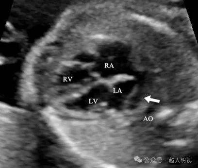 心脏彩超四腔心解剖图图片