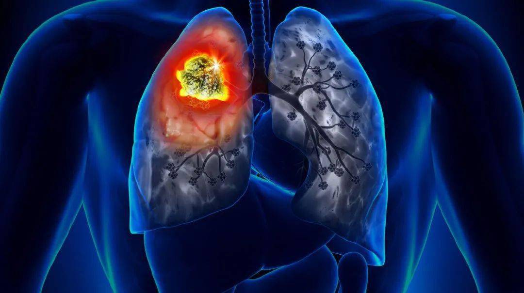 Cell子刊】四川大学刘伦旭/沈慎思团队揭示肺腺癌进展机制和治疗干预 