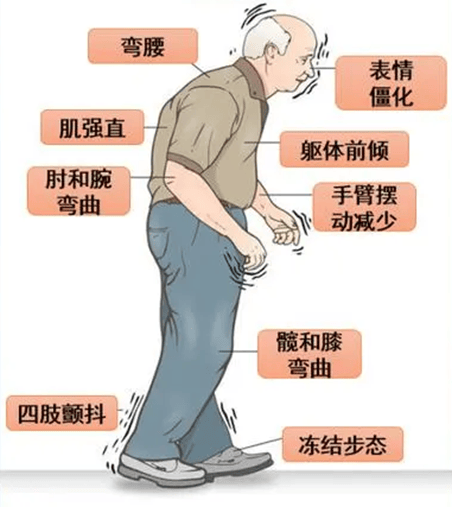 "僵"是指肌肉变得紧绷,四肢活动的时候感到僵硬,不灵活."抖"是指手